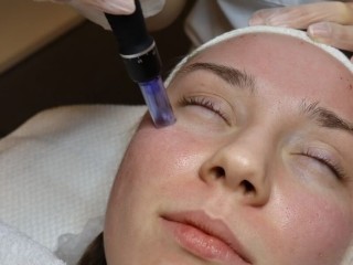 Peeling facial en salón Carolinas